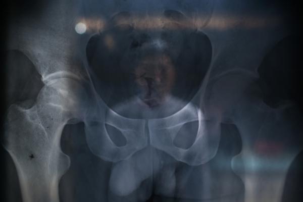 不知情的当地村民直到2005年仍食用污染田地生产的大米,不少村民被检测出镉超标。10年前,黄怀权的髋关节股骨头坏死,手术后,他丧失了劳动能力。 权义 澎湃资料